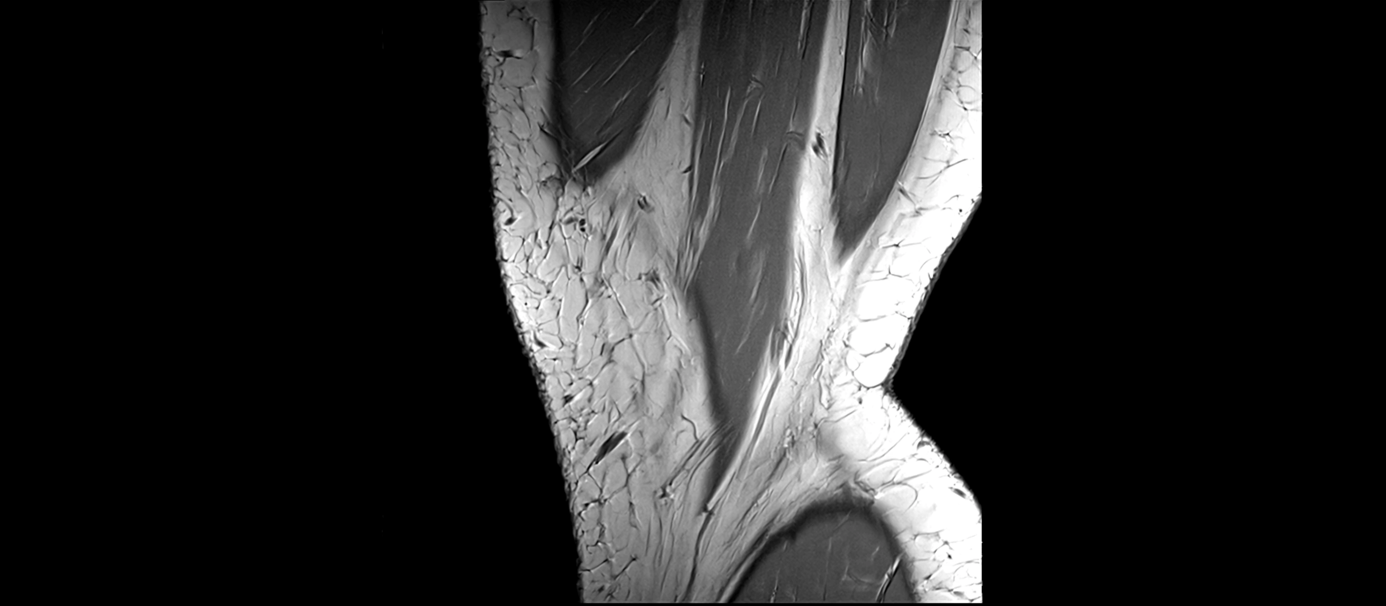 MRI sagittal  ligaments cross sectional anatomy 3T  radiology  image-img-00001-00004.webp